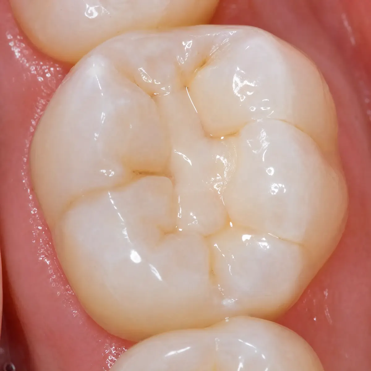 Gebrochener Molar – CEREC-Krone – CEREC-Ergebnis, Zahnarztpraxis Spring Berlin-Tegel Gebrochener Molar – CEREC-Krone: Ergebnis nach der CEREC-Keramikversorgung