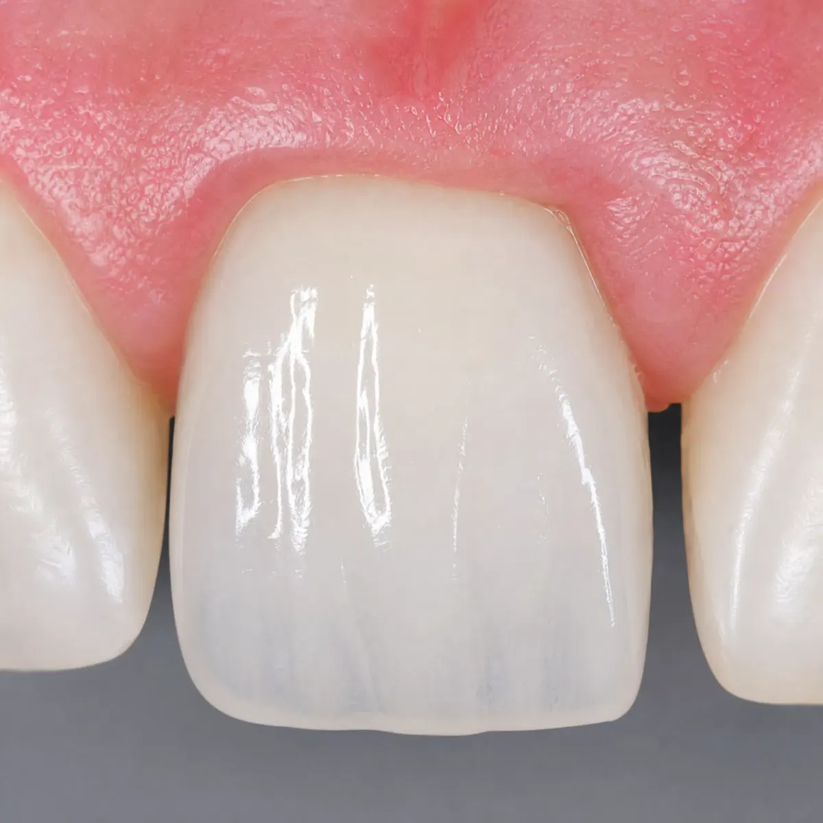 Frontzahn-Veneer mit CEREC – CEREC-Ergebnis, Zahnarztpraxis Spring Berlin-Tegel Frontzahn-Veneer mit CEREC: Ergebnis nach der CEREC-Keramikversorgung
