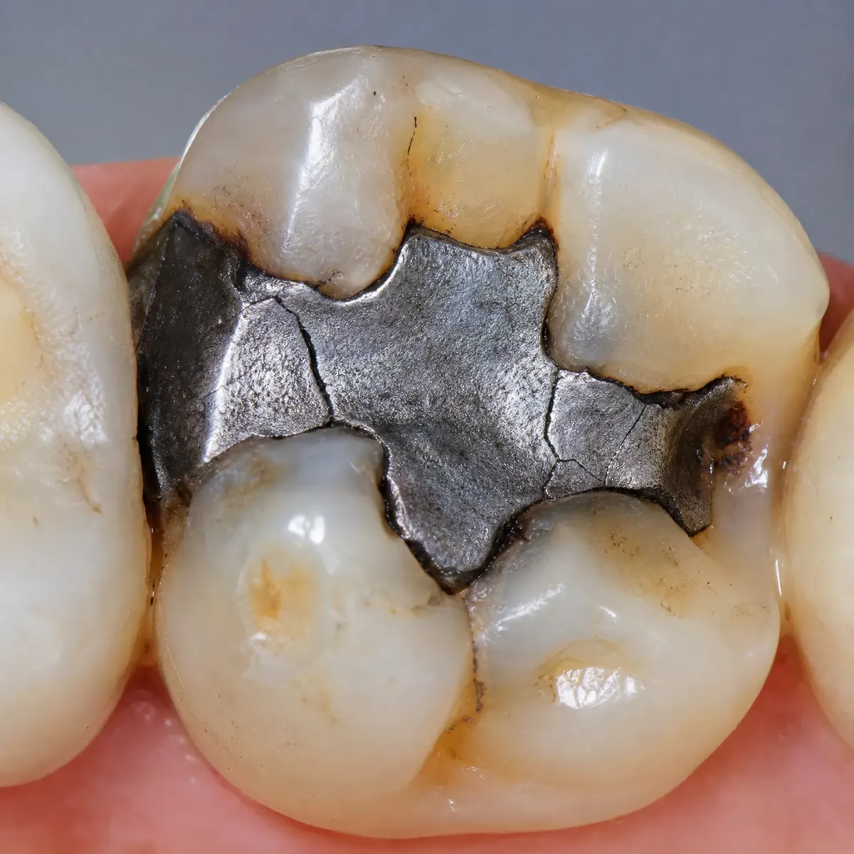 Amalgam-Ersatz durch CEREC-Inlay – Ausgangssituation vor CEREC in Berlin-Tegel Amalgam-Ersatz durch CEREC-Inlay: Ausgangssituation vor der CEREC-Behandlung