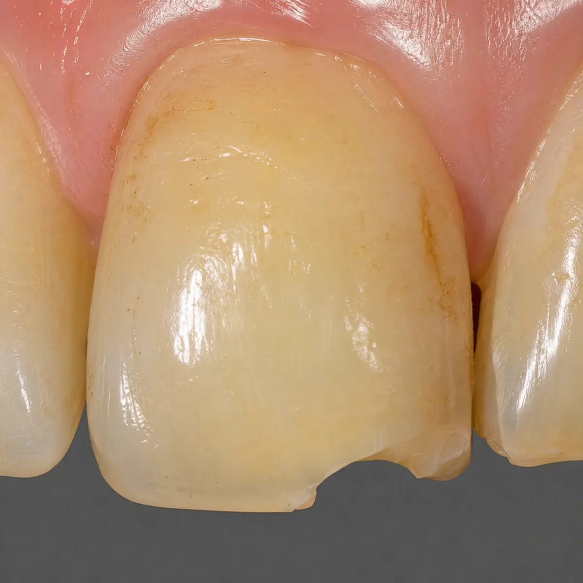 Frontzahn-Veneer mit CEREC – Ausgangssituation vor CEREC in Berlin-Tegel Frontzahn-Veneer mit CEREC: Ausgangssituation vor der CEREC-Behandlung